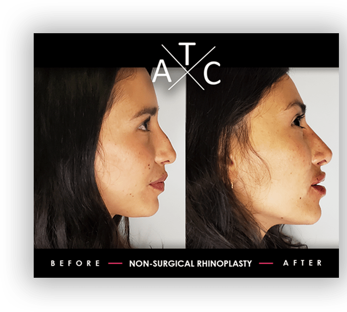 Non-Surgical Rhinoplasty Training Results 2